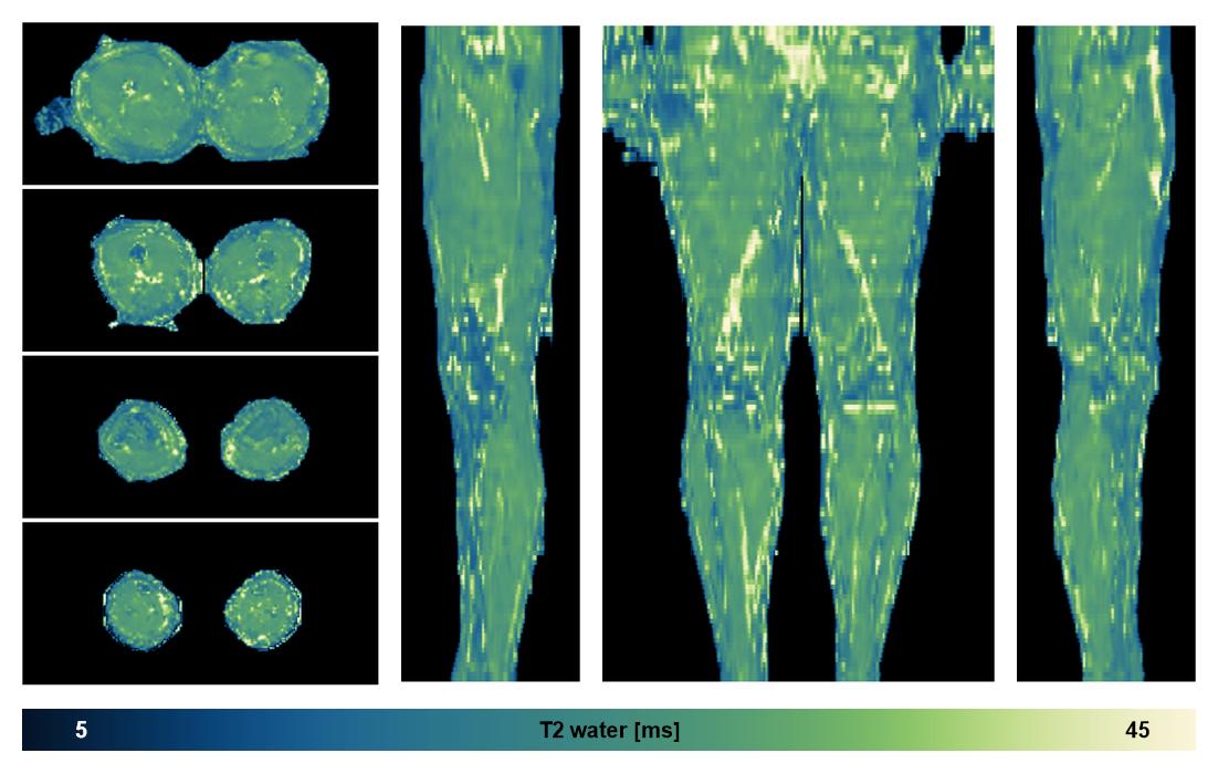 The water only T2 relaxation time of the lower extremity obtained from multi echo spin echo t2 mapping with EPG based reconstruction.